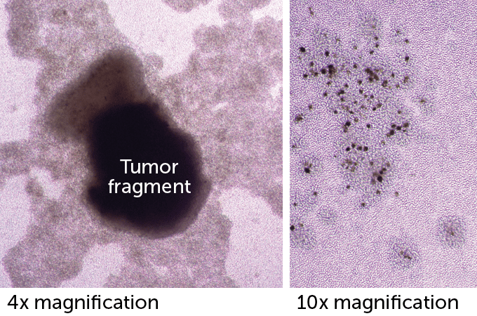 Two side-by-side images. On the left, with 4x magnification, a large black tumor fragment. On the right, with 10x magnification, tumor-infiltrating lymphocytes destroy. the tumor.